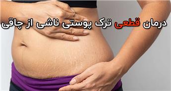 درمان قطعی ترک پوستی ناشی از چاقی