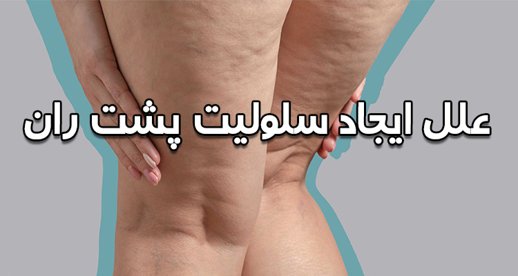 علت ایجاد سلولیت پشت ران